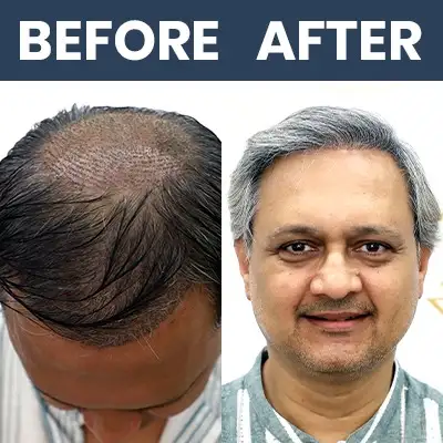 Hair Result - Sunil Barve_12_07_24